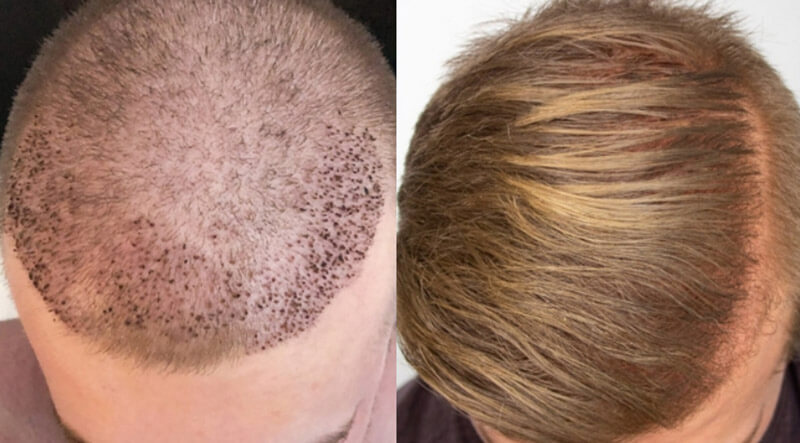 Aesthetic Hair Restoration, Houston, Texas